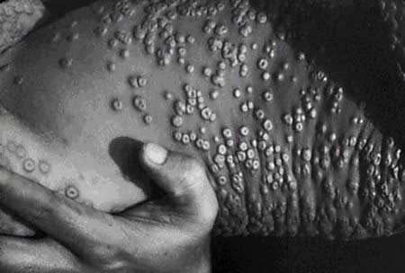 Smallpox
